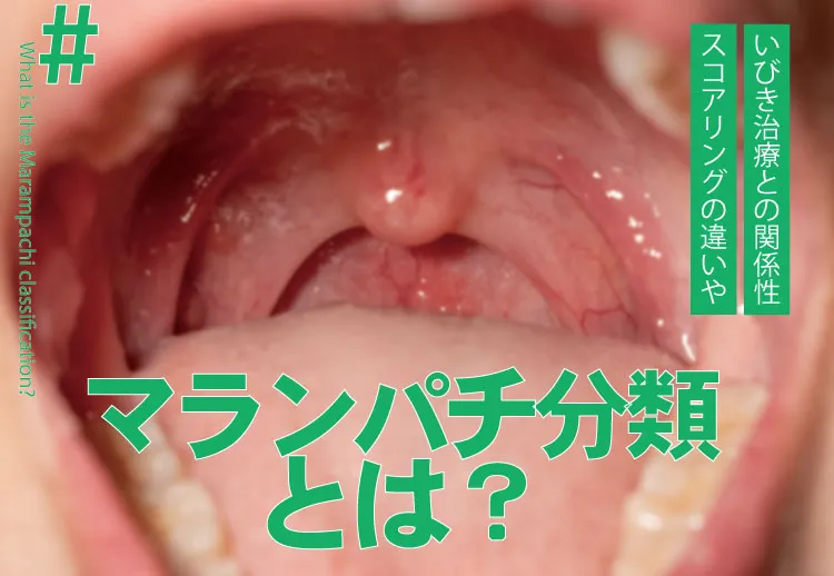 マランパチ分類とは?スコアリングの違いやいびき治療との関係性を解説