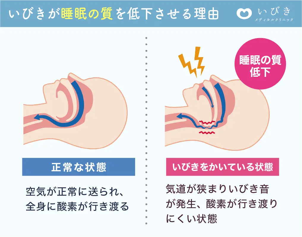 正常な喉といびきをかく人の喉の断面比較図 - 気道の違いを解説