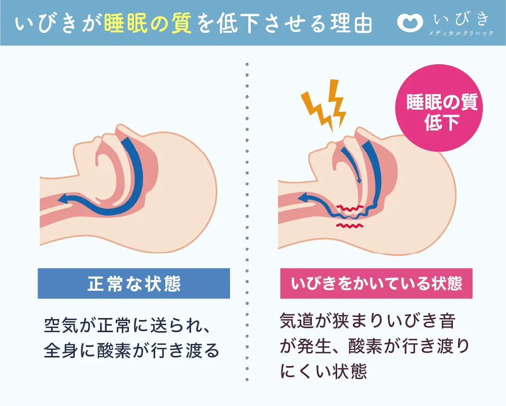 正常な喉といびきをかく人の喉の断面比較図 - 気道の違いを解説